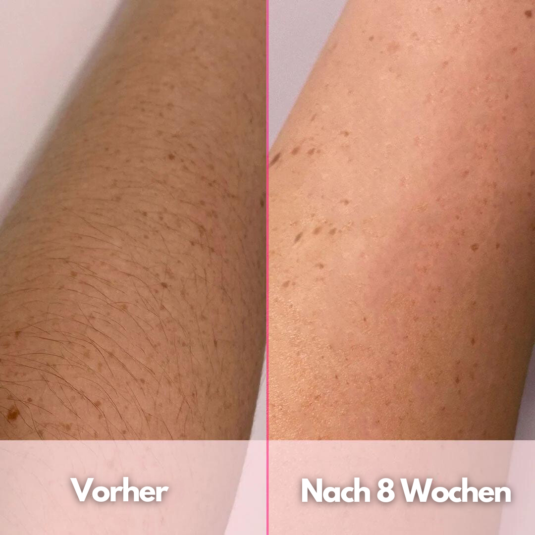 SilkSkin PRO™ - IPL Dauerhafte Haarentfernung für Zuhause