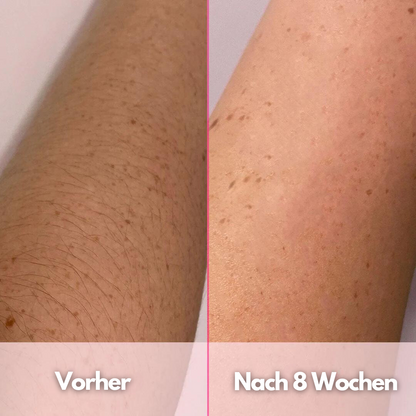 SilkSkin PRO™ - IPL Dauerhafte Haarentfernung für Zuhause